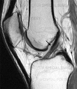 MRI image of a healthy ACL.