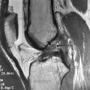 MRI of Complete ACL tear.