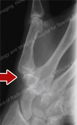 X-ray of the hand with an arrow pointing to an arthritic basal joint of the thumb