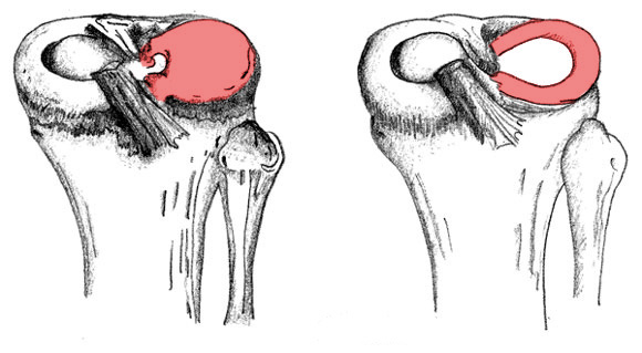 Diagram of a discoid meniscus and a normal meniscus 