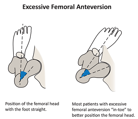 Illustration: Excessive Femoral Anteversion