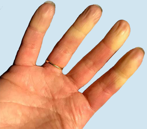 Raynaud's phenomenon showing discoloration in multiple fingers.