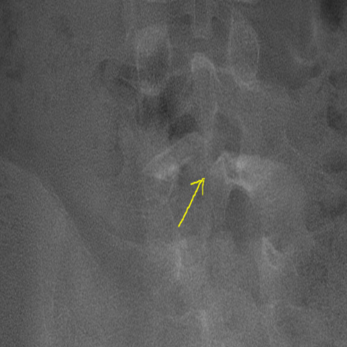An X-ray showing a spina bifida defect.