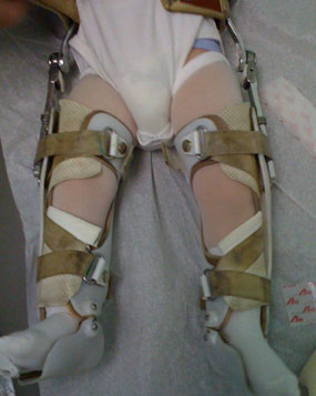 photo of a child with blount's disease in a brace