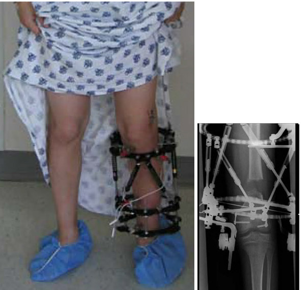 Circular external fixation frames. A child wearing a tibial spatial frame at left, and an X-ray of a femoral frame showing its internal workings.