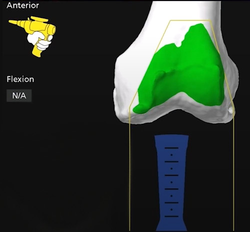 Computer navigation of orthopedic surgery robotic arm before incisions.