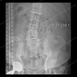 X-ray showing a more progressive case of degenerative scoliosis
