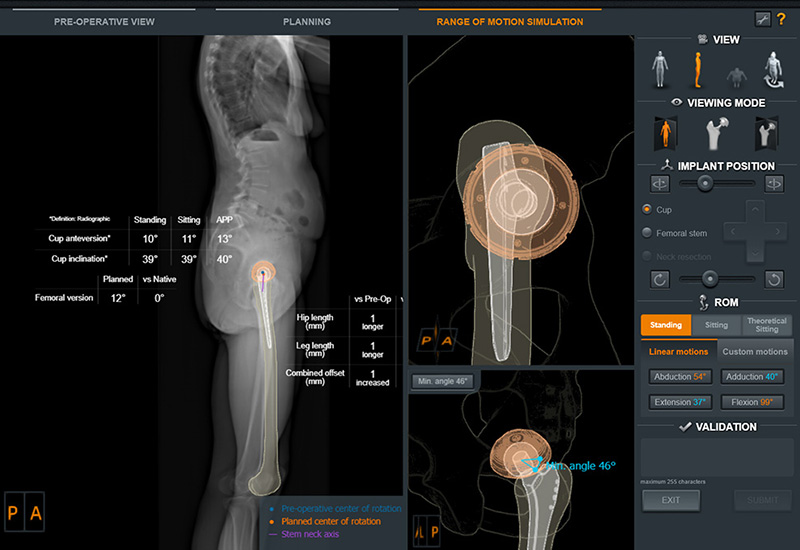 Photo showing EOS imaging preoperative patient view with 3D renderings and measurement of implant placement.