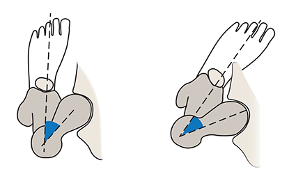 Illustration of a femoral anteversion