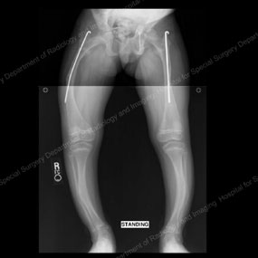 X-ray of a growing child with osteogenesis imperfecta treated with intramedullary rods