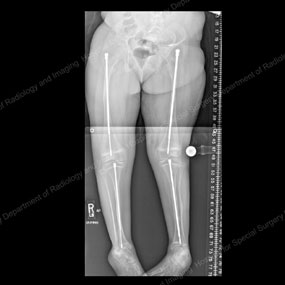 X-ray of a growing child with osteogenesis imperfecta who was treated with Fassier-Duval rods after outgrowing intramedullary rods.