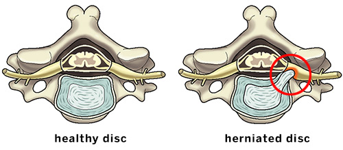 Illustrations of healthy spinal disc and bulging, herniated disc.