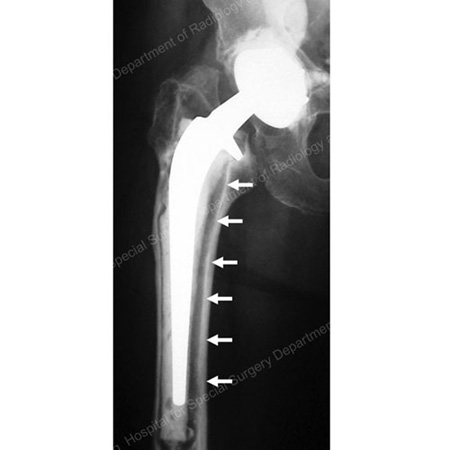 X-ray image showing loose total hip replacement prosthesis.