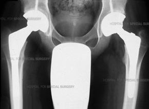 Post-op X-ray of patient who has undergone arthroplasty of both hips