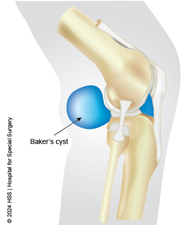 posterior knee pain and baker's cyst