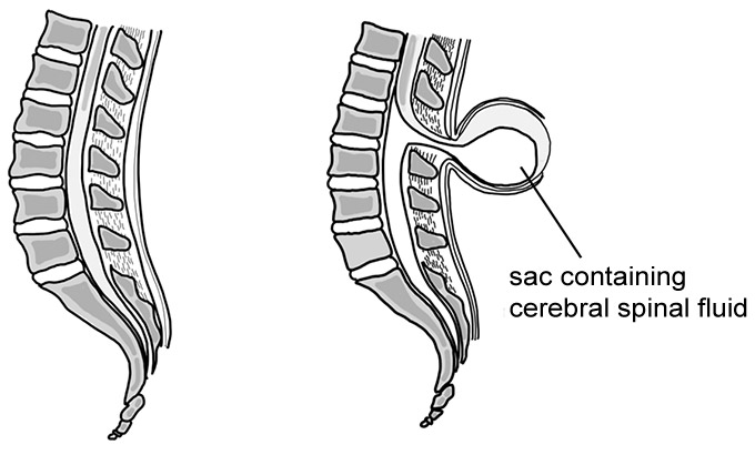 Illustration of the lower spine showing normal structure verses that of a posterior spina bifida defect.
