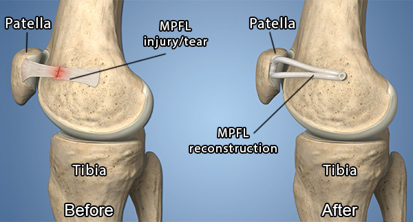 Diagram showing torn or injured medial patellofemoral ligament (MPFL) and a postsurgical reconstructed MPFL.