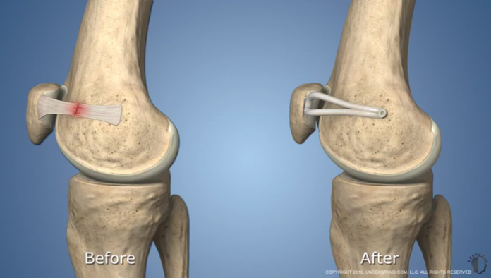 Illustration of damaged and repaired MPFL ligament, labeled before and after.
