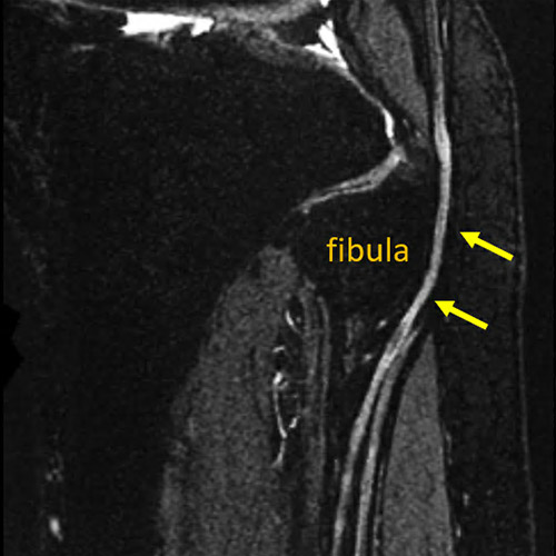 MR neurography image showing an irriated nerve at the fibula.