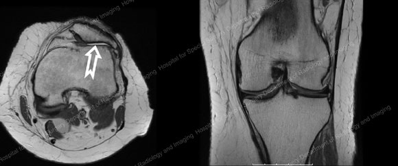 MRI images of a patient with severe arthritis in the patellofemoral compartment in the knee