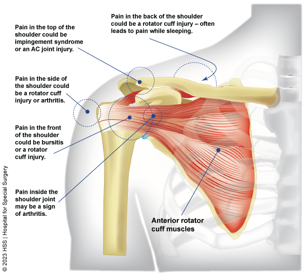 A chart illustration of the shoulder showing possible diagnoses by location of pain.