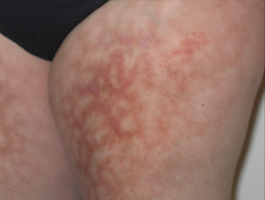 Photo of small-vessel vasculitis rash known as “livedo.”