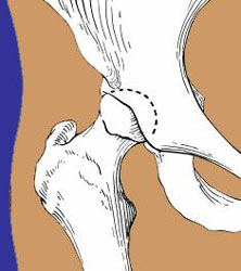 illustration of the hip joint from an article about hip arthroscopy