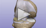 Graphic: Partial knee replacement animation