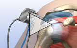 Graphic: Partially torn rotator cuff animation