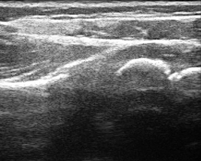 Ultrasound image of shoulder with normal brachial plexus findings.