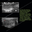 Image - Ultrasound of the Month Case 72 thumbnail