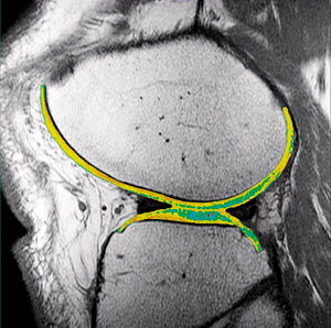 Lateral view of the knee using T2 mapping.