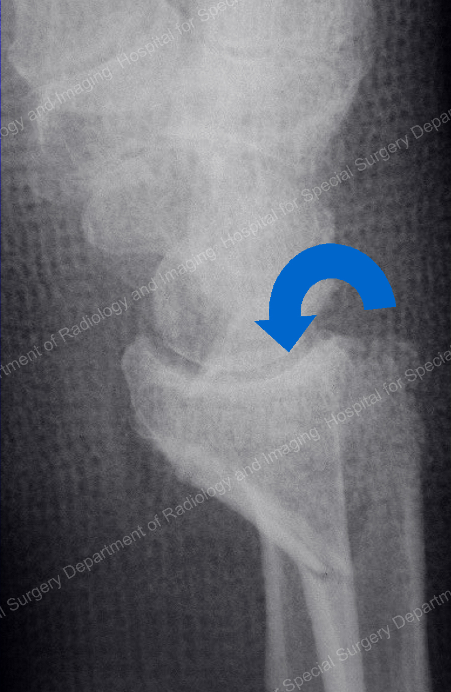 X-ray image of Smith (volar) fracture
