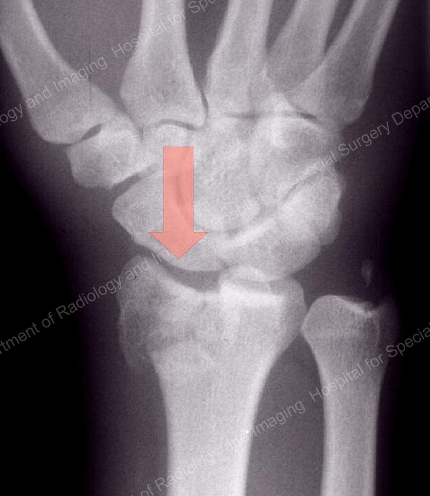 X-ray image showing a compression fracture of the distal radius