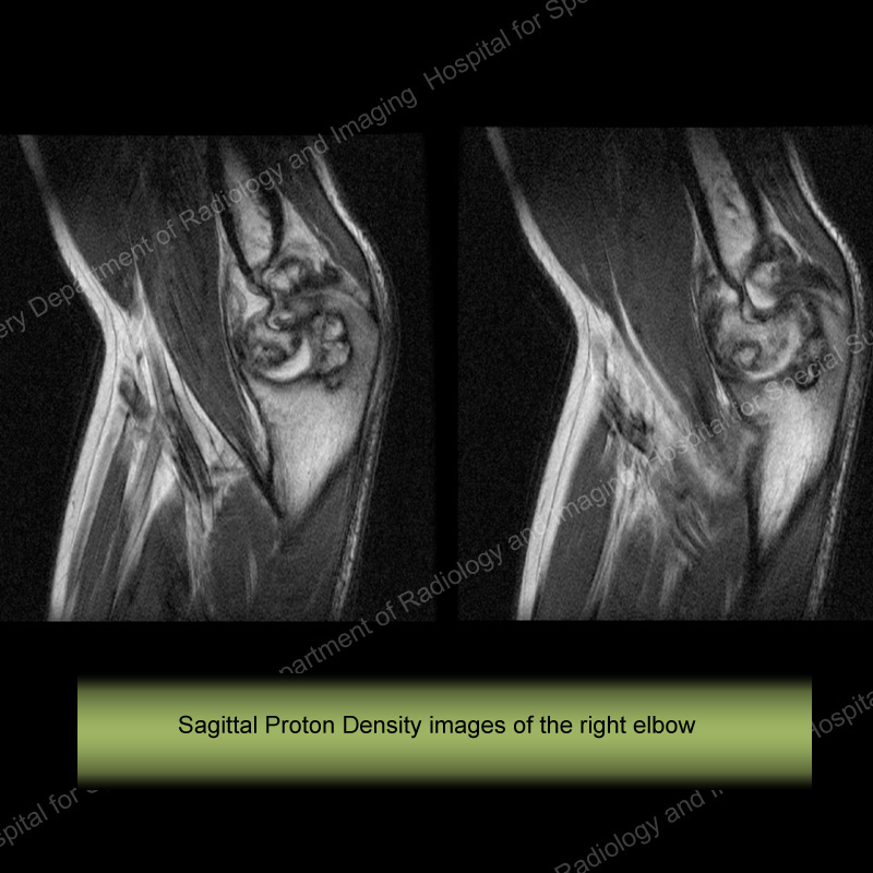 Sagittal Proton Density Images of the Right Elbow