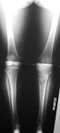 Luis, Follow up thumbnail of an x-ray, Limb Lengthening, osteotomy proximal tibia, ilizarov taylor spatial frame, deformity correction, arthritis prevention