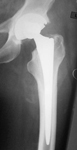 Helen, Follow up thumbnail of an x-ray, Limb Lengthening, total hip replacement, THR