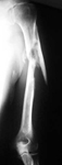 Max, Pre-op thumbnail of an x-ray, Limb Lengthening, Humerus Nonunion, fractured humerus