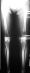 Nancy, Post-op thumbnail of an x-ray, Limb Lengthening, femur osteotomy, gradual lengthening, EBI frame