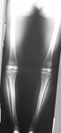 Brenda, Pre-op thumbnail of an x-ray, Limb Lengthening, bowleg alignment, genu valrum