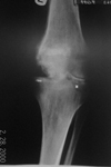 daniel, pre-op thumbnail of an x-ray, limb lengthening, open knee fracture, infection, deformity, osteomyelitis, septic arthritis