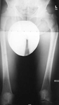 Philip, Pre-op thumbnail of an X-ray, Limb Lengthening, Femur Malunion, deformity, external rotation, back pain