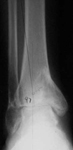 Claudia, Pre-op thumbnail of an x-ray, Limb Lengthening, Ankle Distraction, post-traumatic arthritis, varus deformity