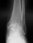 Ayaka, Follow up thumbnail of an X-ray, Limb Lengthening, improved ankle joint space, talus improvement