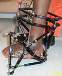 Dale, Post-op thumbnail Image, Limb Lengthening, Clubfoot, complex foot deformity, V-type osteotomy, miter spatial frame