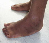 Dale, Pre-op thumbnail Image, Limb Lengthening, Clubfoot, complex foot deformity