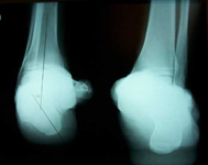 Dale, Pre-op thumbnail of an x-ray, Limb Lengthening, Clubfoot, complex foot deformity