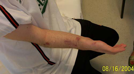 Petar, Follow up thumbnail Image, Limb Lengthening, wrist deformity correction, wrist/forearm lengthened