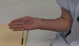 Petar, Follow up thumbnail Image, Limb Lengthening, wrist deformity correction, wrist/forearm lengthened