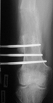 Sean, Post-op thumbnail of an x-ray, limb lengthening, osteotomy, femur osteotomy, monolateral frame, gradual lengthening